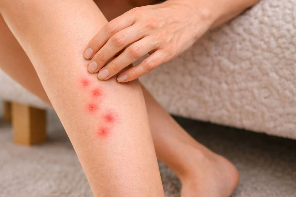 Могут ли укусы быть признаком заражения помещения